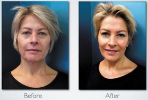 LED Photo Therapy - Face Fitness Professional Skin Care - Before and After