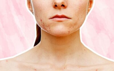 Acne Clearing Program at Face Fitness Professional Skin Care
